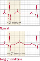 Congenital Long QT Syndrome ScienceDirect, 49% OFF