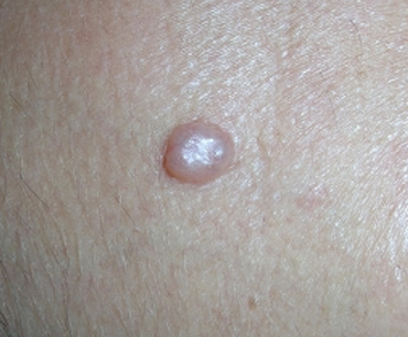 How Fast Nodular Melanoma Goes from Flat to Pencil Eraser Height