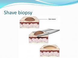 Mole Grew Back Rapidly After Shave Biopsy Was Normal Scary Symptoms   Shave Biopsy 