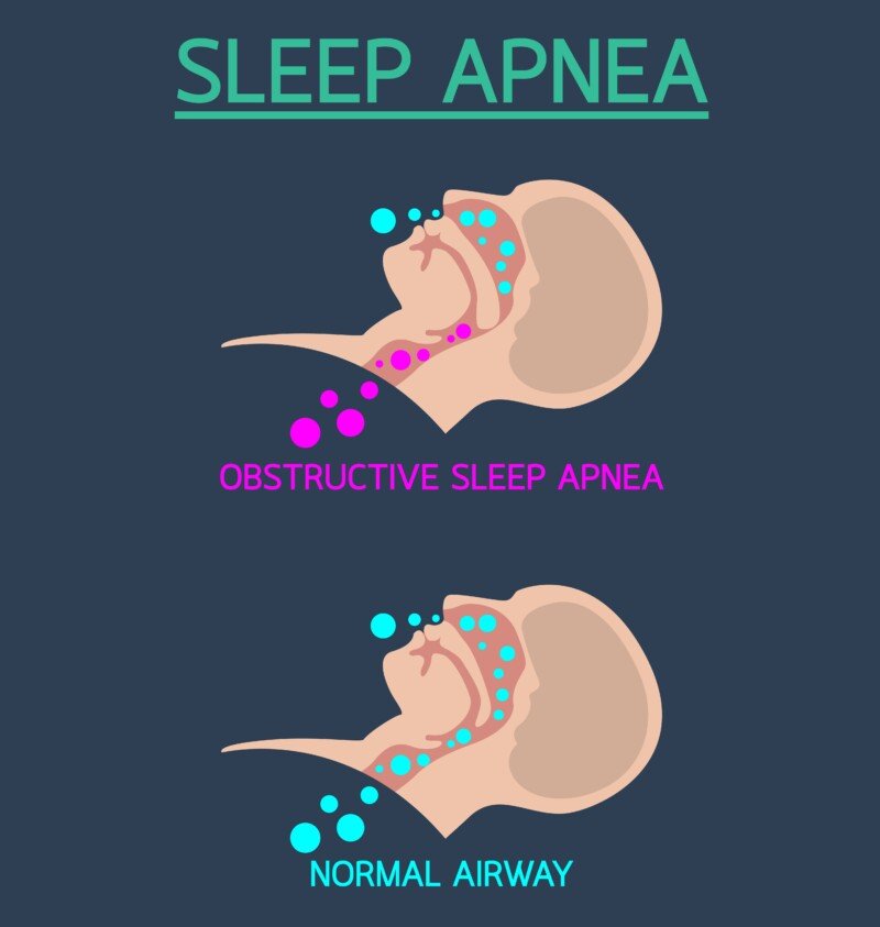 Can You Fake Sleep Apnea and Fool the Test ? Yes and No » Scary Symptoms