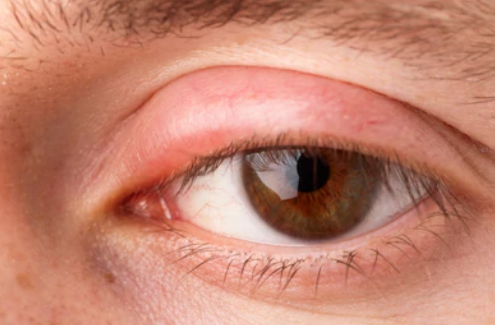 Itchy, Swollen and Peeling Eyelids: Causes and Solutions