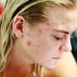 Sudden Acne Breakout in Healthy Adults: Causes & Solutions