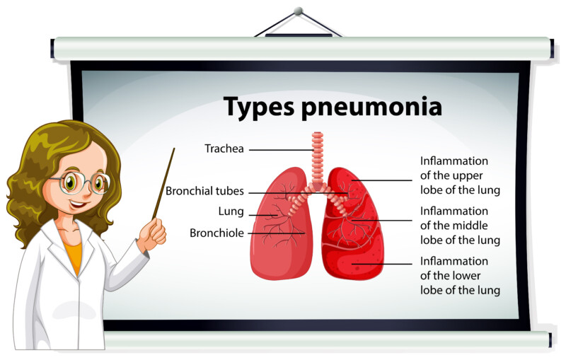 Can NonWalking Pneumonia Go Away On Its Own? » Scary Symptoms