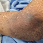 Why Do Very Elderly People Have Purple Bruises on Arms?