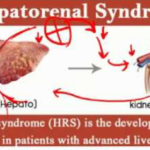 Can Ischemic Hypoxic Liver Cause Hepatorenal Syndrome 1 ?