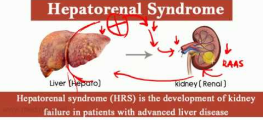 Can Ischemic Hypoxic Liver Cause Hepatorenal Syndrome 1 ?