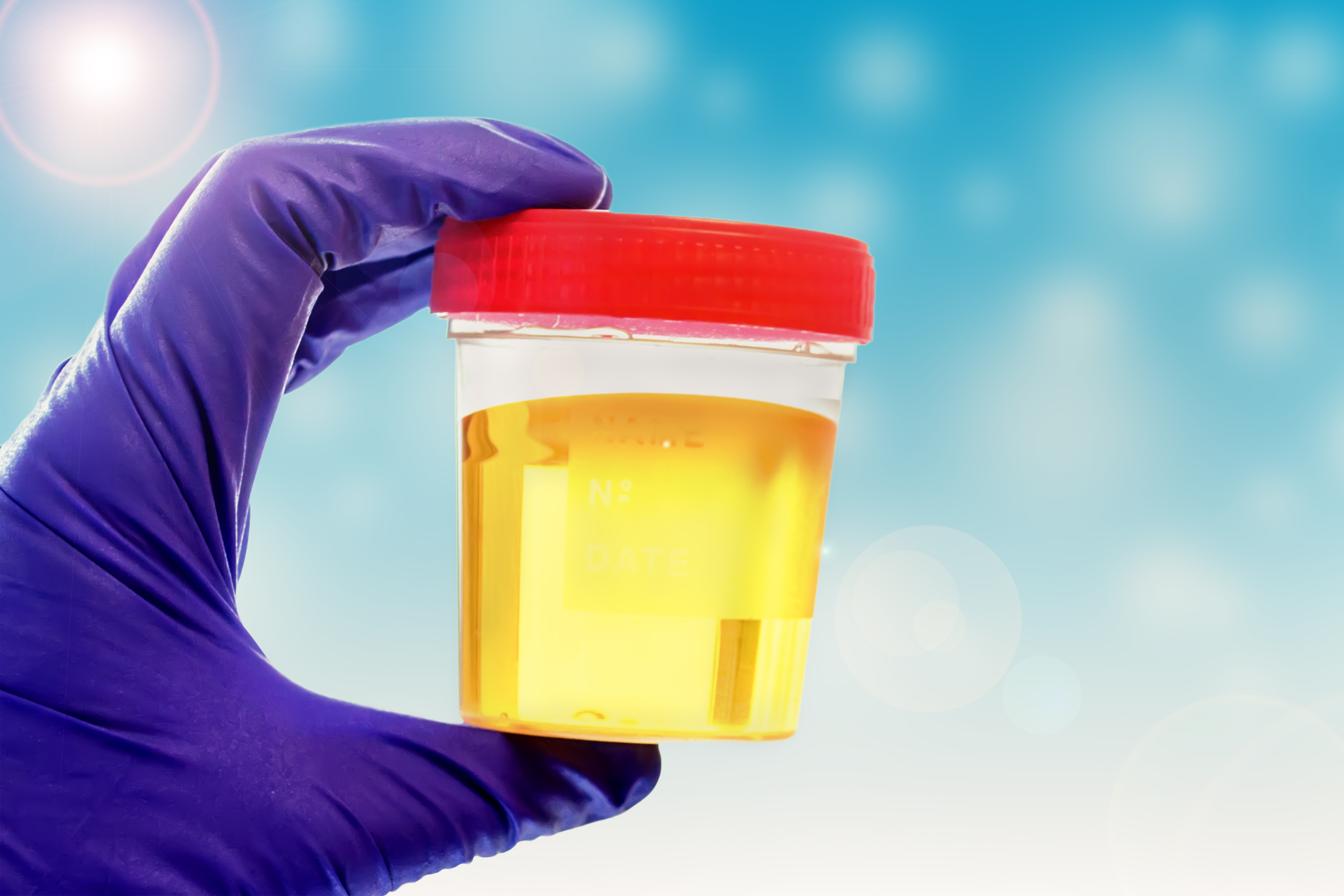 Can Cancer Cause a Chemical Smell in Urine?