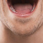 Can an Acoustic Neuroma Affect the Tongue?