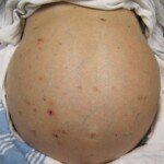 Can Acute Liver Damage from Heart Failure Cause Ascites?