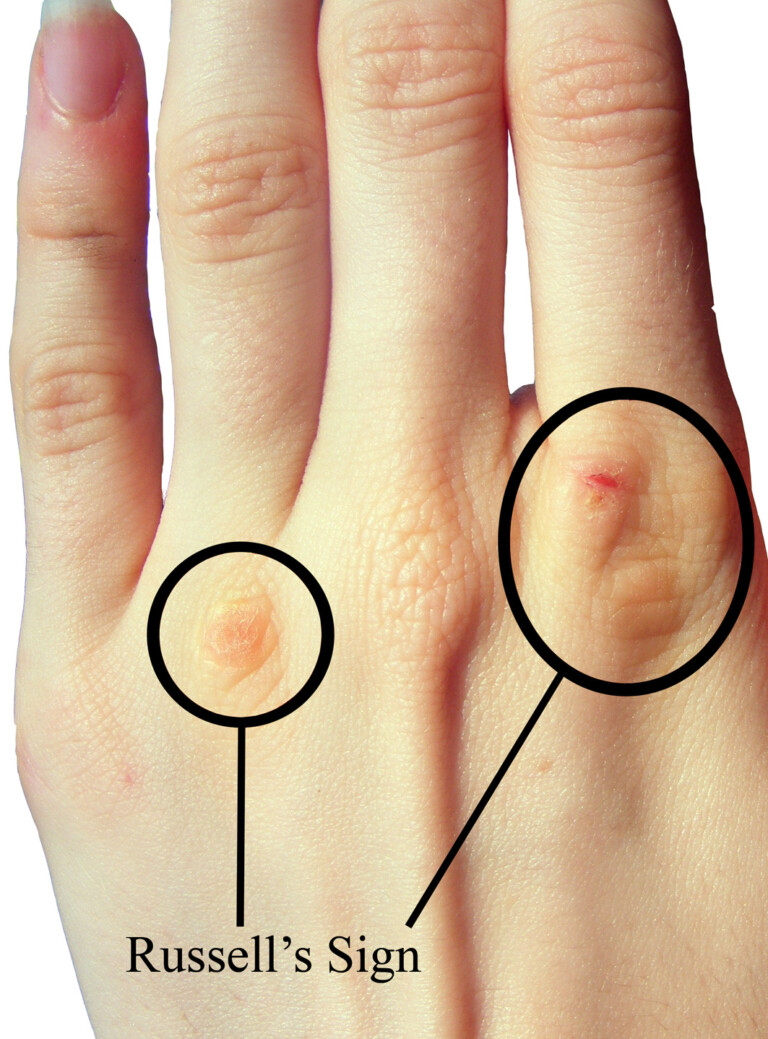 Can Bulimia Cause TMJ Disorder or a Protruding Jaw? » Scary Symptoms