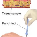 Does a Punch Biopsy for Mole Removal Hurt?