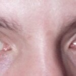 Cause of One Pupil Temporarily Dilated, No Response to Light
