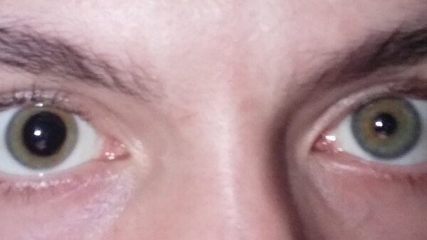 one pupil dilated suddenly