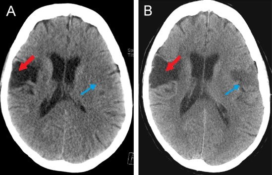 Coumadin’s Effectiveness Against Stroke in Elderly without A-Fib?