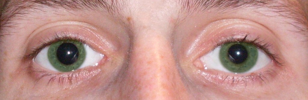 itchy eye one pupil dilated