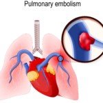 Can a Pulmonary Embolism Kill You on the Way to a CT Scan?