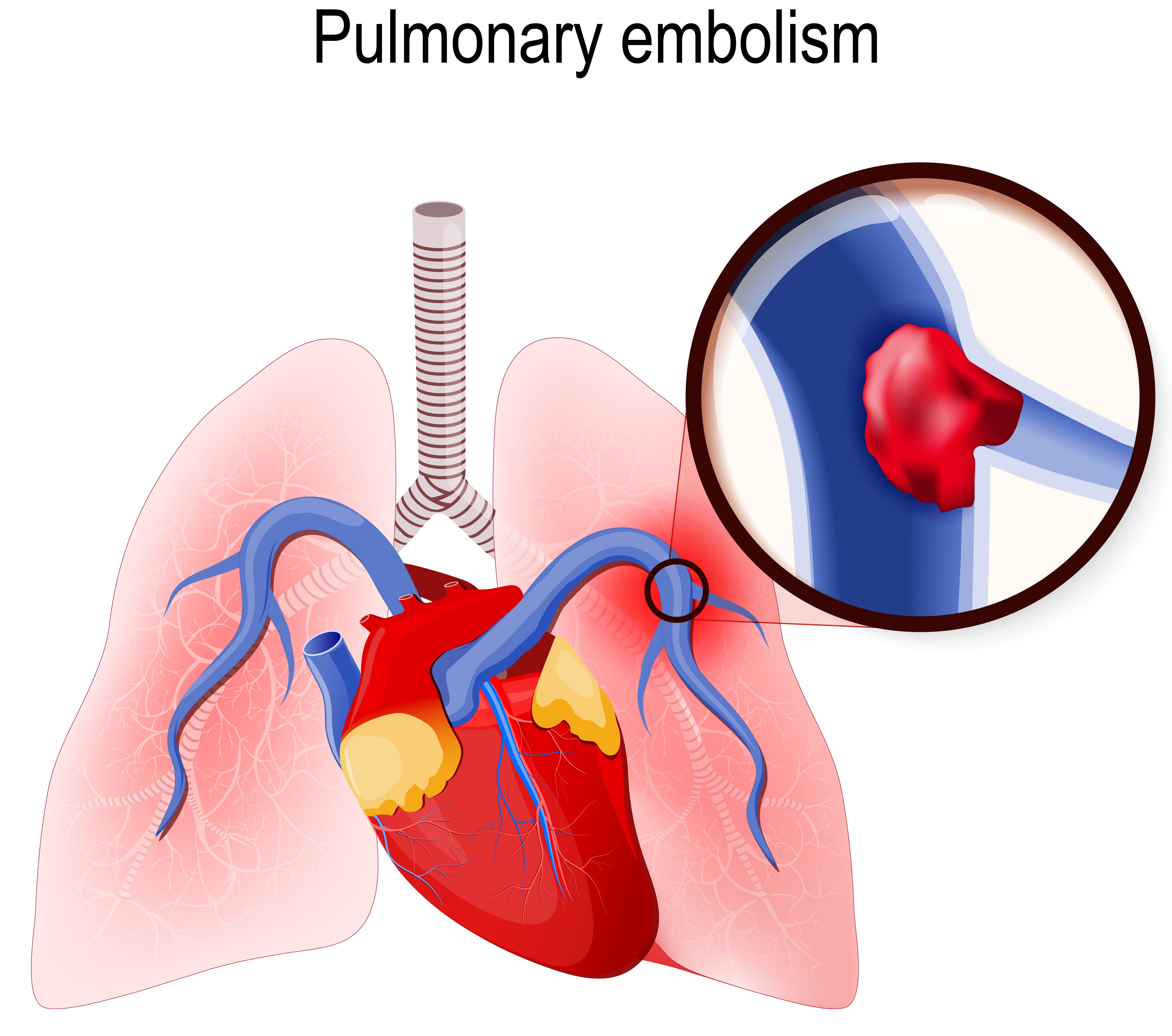 Can a Pulmonary Embolism Be Diagnosed without Imaging?