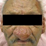 What is Rhinophyma and Its Link to Skin Cancer