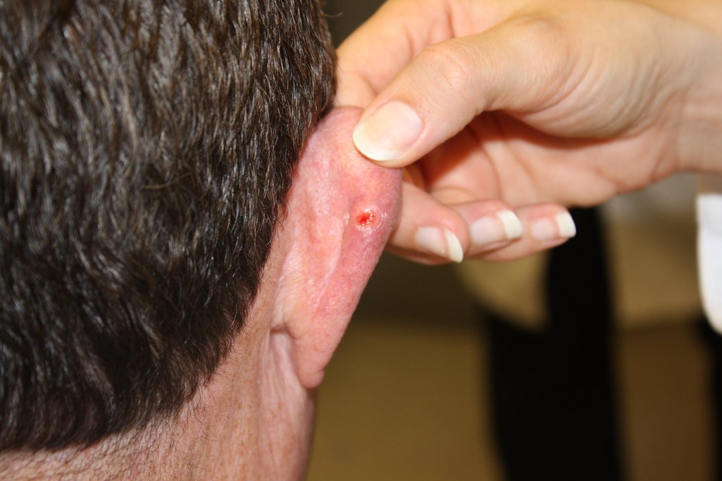 When Cancer Can Mimic an Earlobe Pimple: Know the Signs