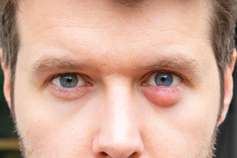 Bump Under Eyelid: Skin Cancer Or Chalazion Cyst? » Scary Symptoms