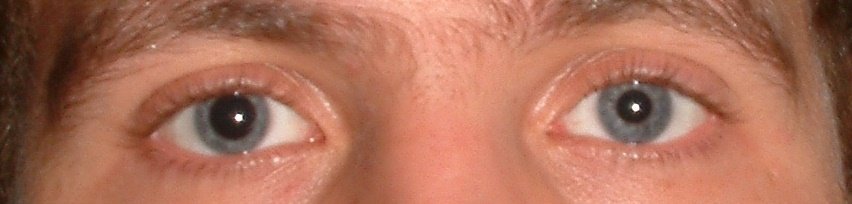 left pupil larger than right