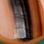 What Are All the Different Colors that Nail Melanoma Can Be ?