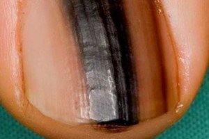 Melanoma of the nail unit: A Complete Overview - DermNet