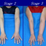 Can a Woman Fly with Arm Lymphedema from Breast Cancer?