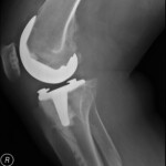 Knee Is Swollen and Hurts 8 Weeks After Replacement Surgery?