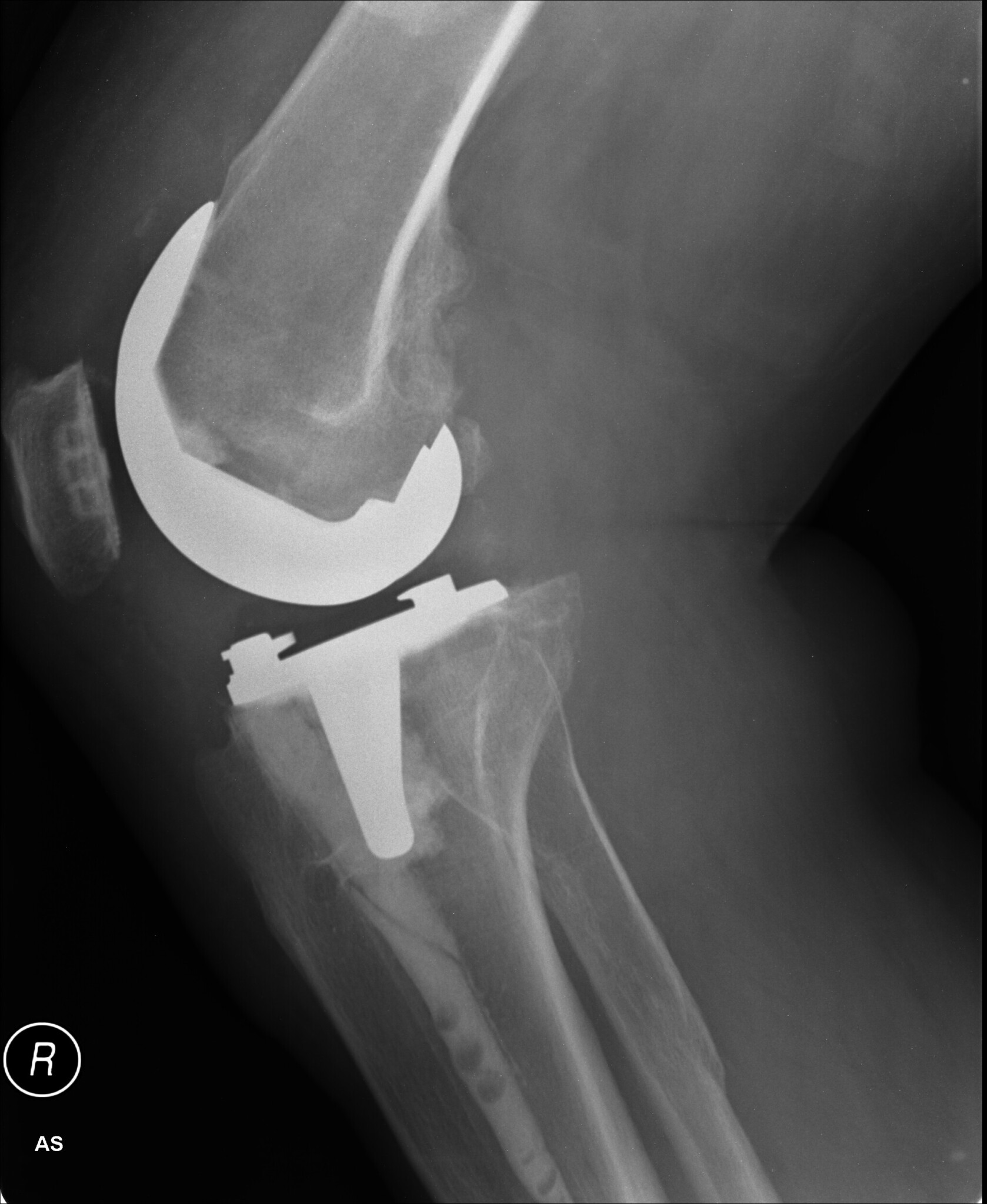 Are You At Risk for a Failed Knee Replacement Joint? » Scary Symptoms