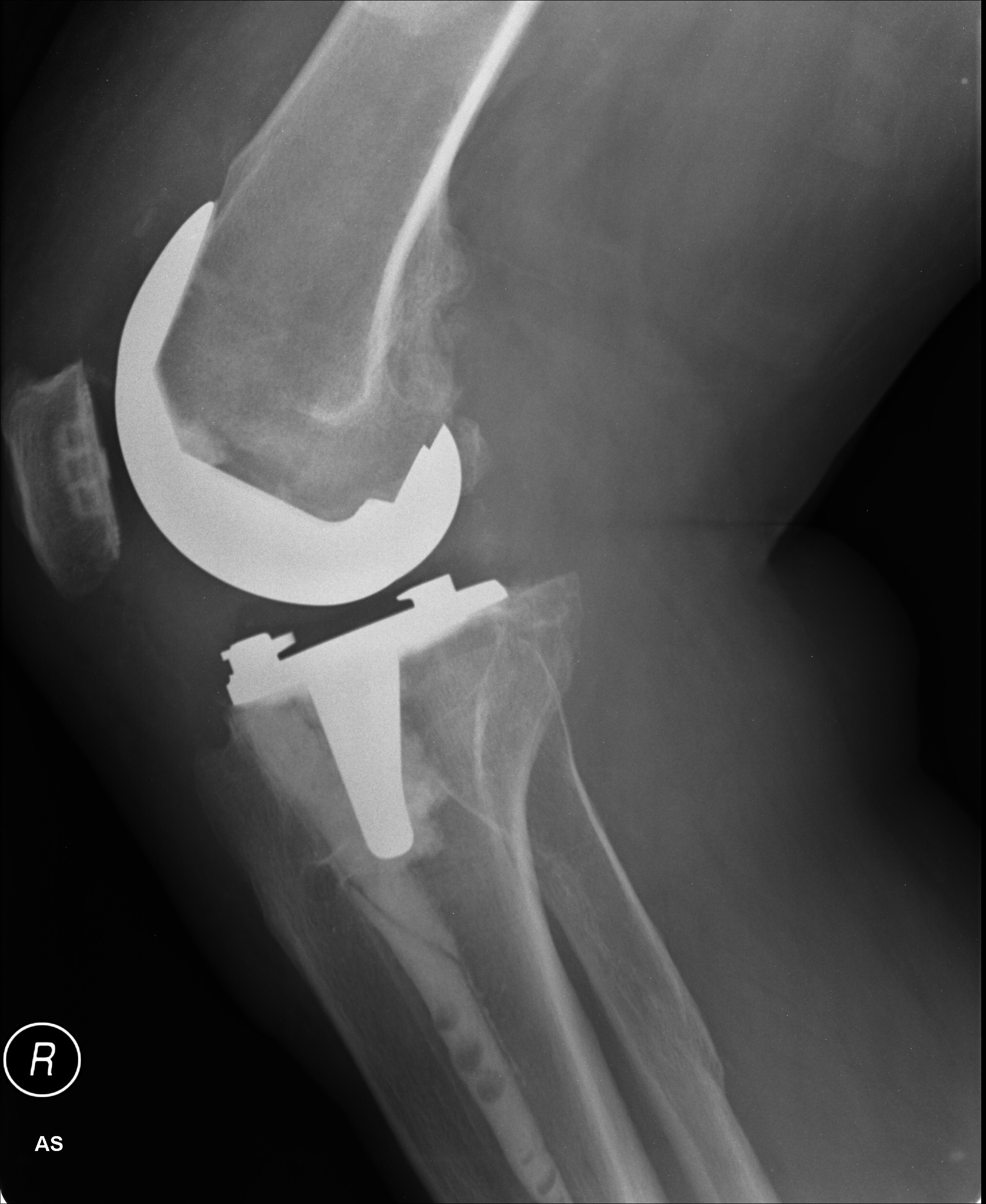 Are You At Risk for a Failed Knee Replacement Joint?