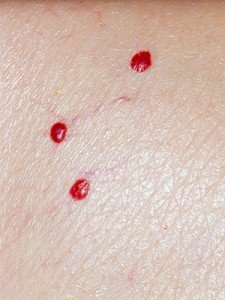 Can a Bad Looking Melanoma Still Be Early Stage? » Scary Symptoms