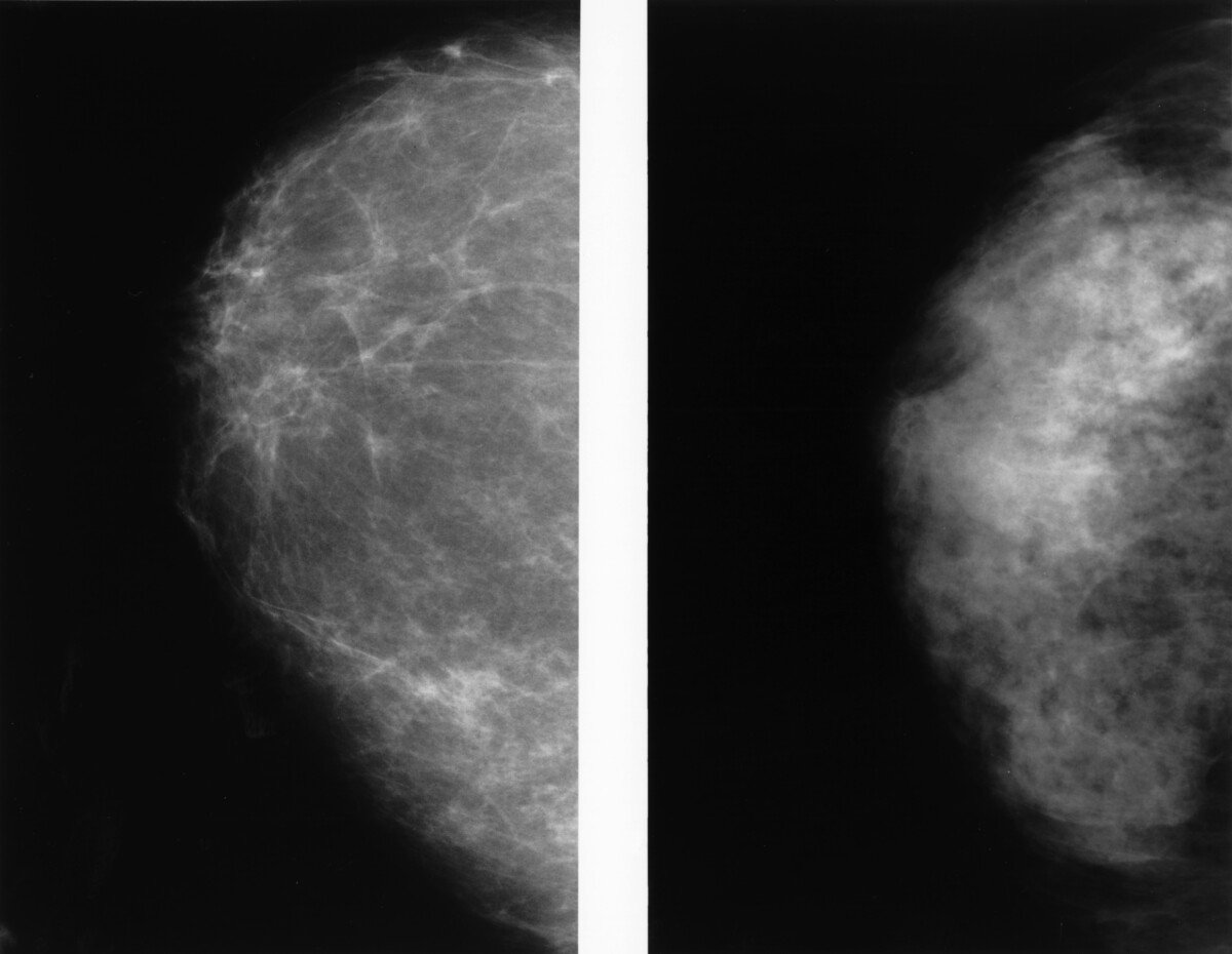 How to Minimize Pain During Core Needle Biopsy for Breast Cancer