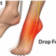 Muscle Twitching Fear: Foot Drop Strength Test Guidelines