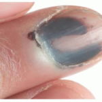 Do ALL Nail Melanomas Have a Hutchinson’s Sign?