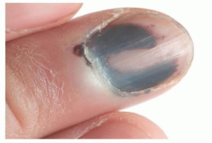 nail melanoma