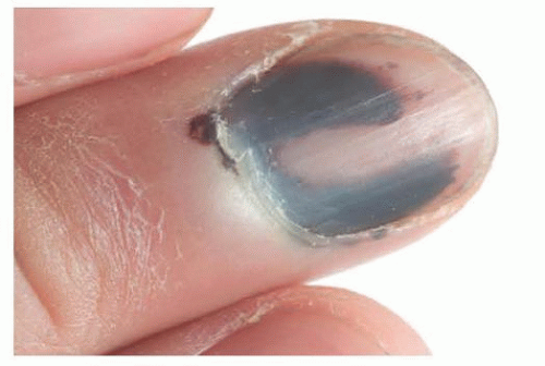 Cureus | Non-Melanoma-Associated Dyschromia of the Proximal Nail Fold |  Article