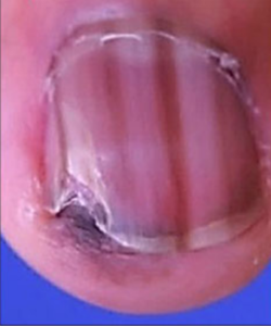 Melanoma. Note the variegated banding plus the Hutchinson's sign at the top of the nail.