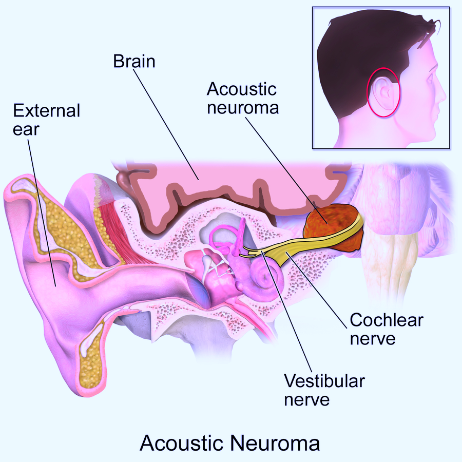 Symptoms of a Small Acoustic Neuroma vs. Large Tumor