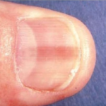 Pink Line or Stripe on Fingernail or Toenail Can Be Melanoma