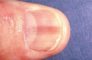 Pink Line Or Stripe On Fingernail Or Toenail Can Be Melanoma Scary Symptoms