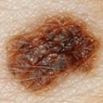 Can a Mole with Three Shades Be Benign?