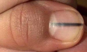 Warning Signs a Nail Melanoma Was Misdiagnosed As Benign » Scary Symptoms