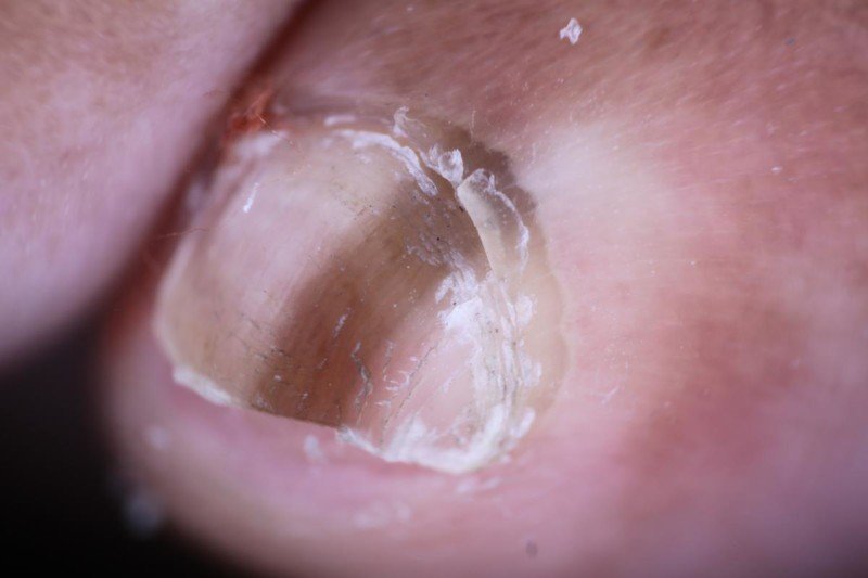 Toenail (Subungual Hematoma) vs. Melanoma Visible Differences » Scary