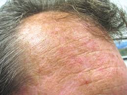 How Fast Actinic Keratosis Turns into Squamous Cell Carcinoma?