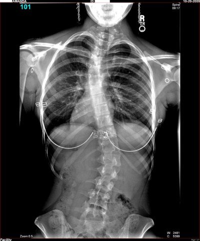 scoliosis stenosis spinal untreated monitored
