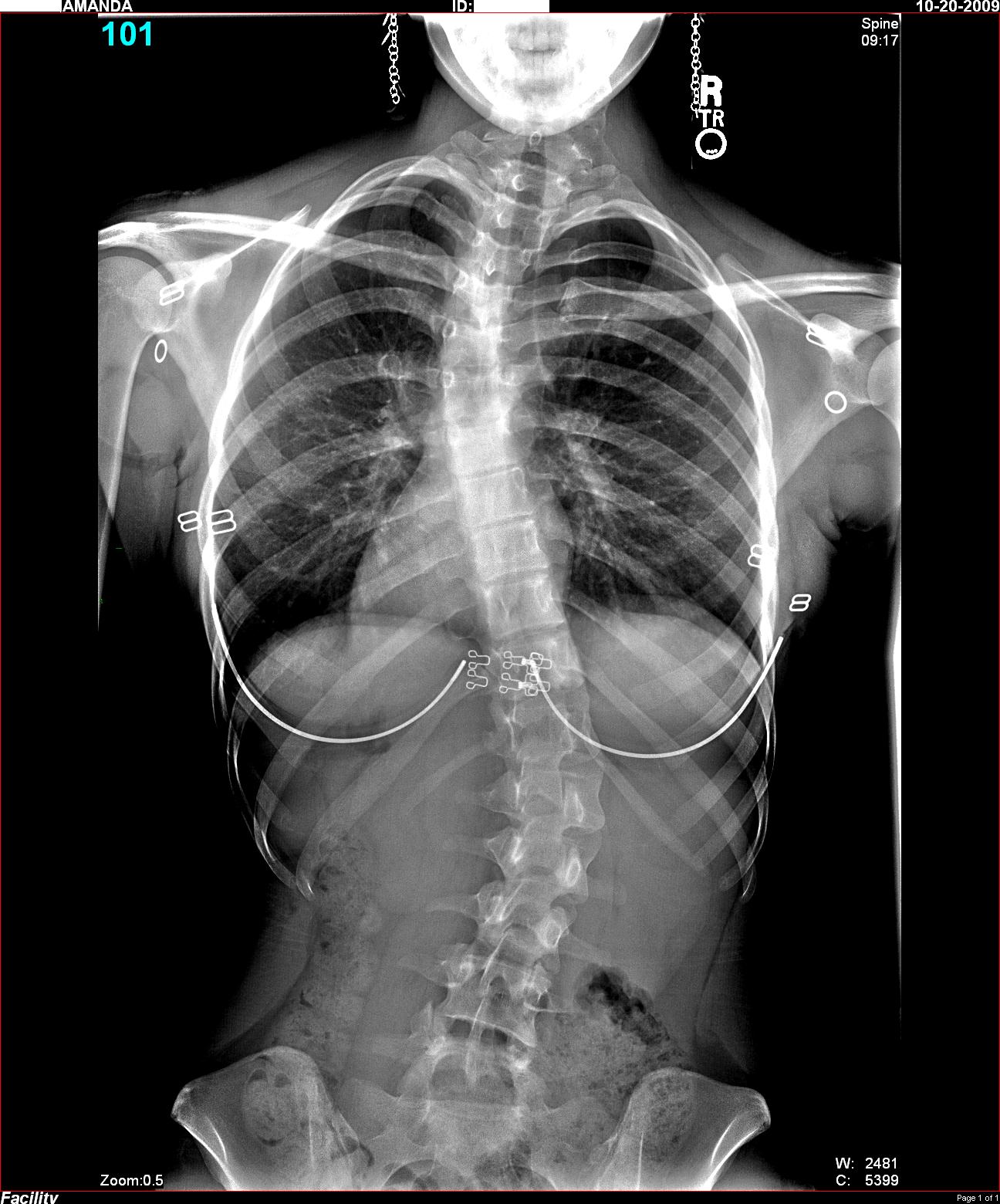 Can Untreated Scoliosis Lead to Spinal Stenosis?