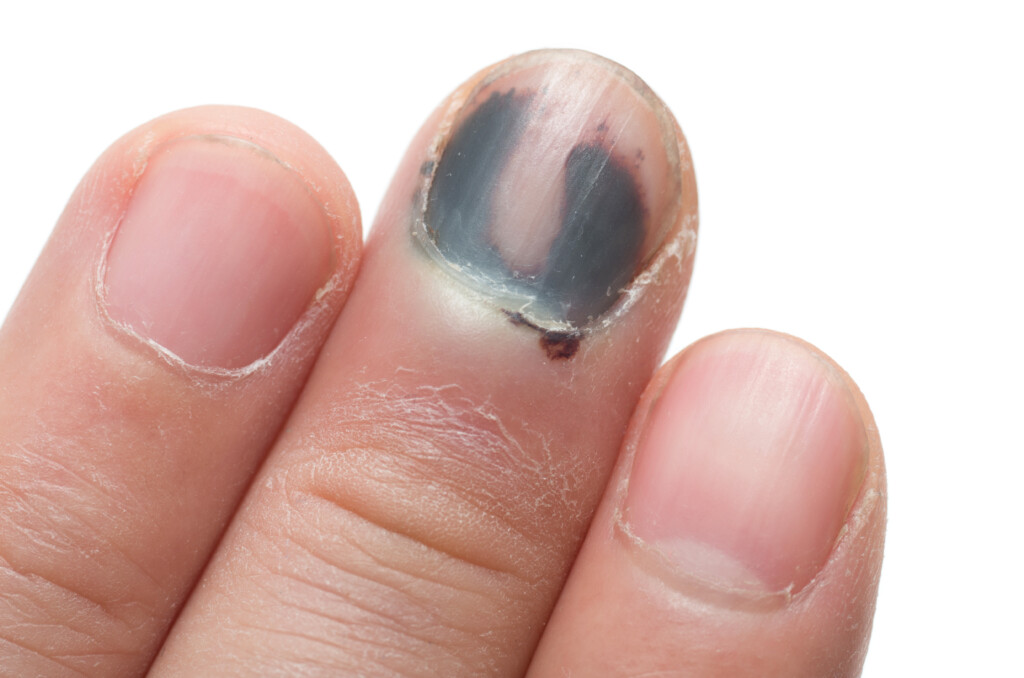 Toenail (Subungual Hematoma) vs. Melanoma Visible Differences » Scary