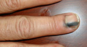 Surgical & Cosmetic Dermatology | Melanonychia striata secondary to  pigmented nail matrix fibroma simulating nodular melanoma