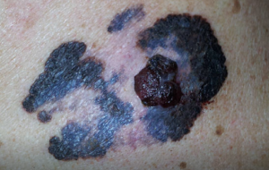 MELANOMA